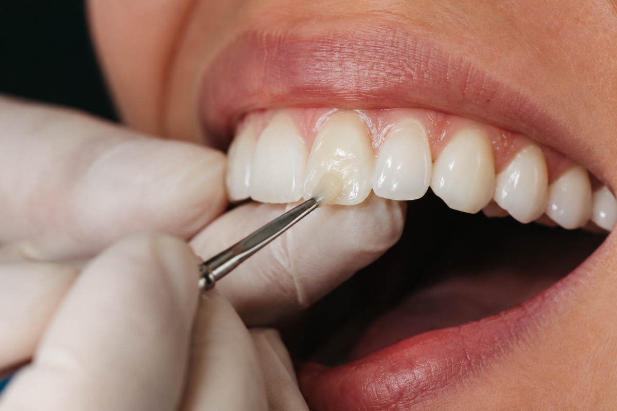 Dental Bonding