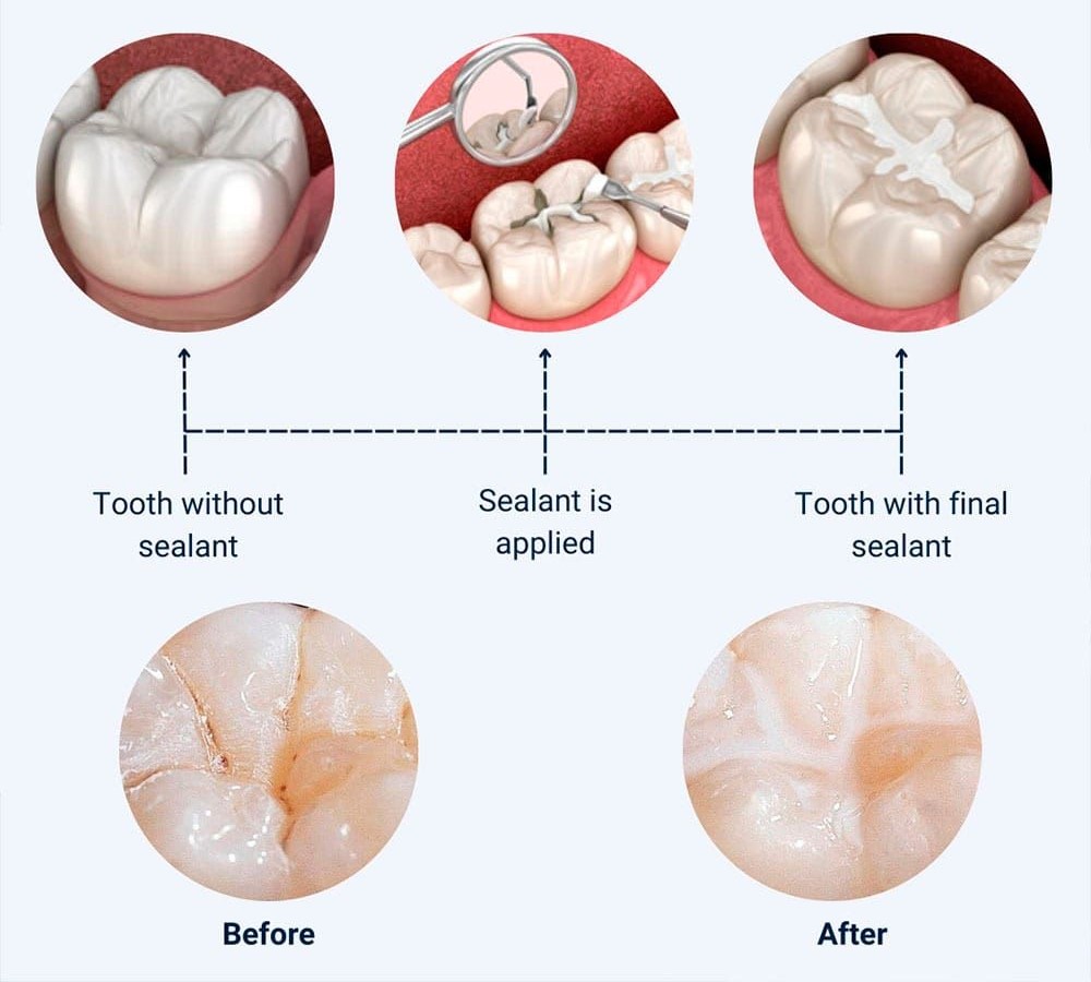 Dental Sealants in Milton, Step-by-Step Procedure and Before & After Comparison Step-by-step dental sealants in Milton procedure diagram showing a tooth without sealant, sealant being applied, the tooth with final sealant, and before-and-after close-ups of a molar's grooves