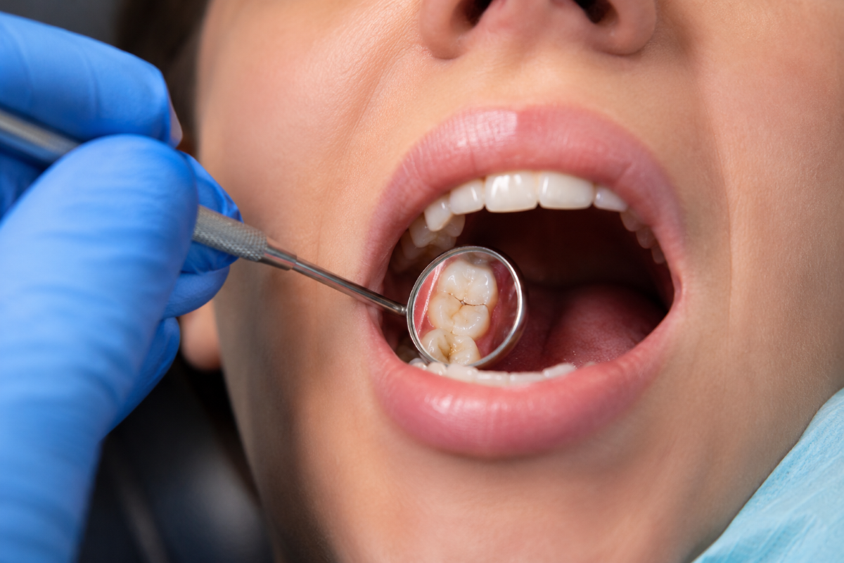 Emergency Dentist in Milton, Urgent Dental Examination of a Broken Tooth | White Dove Dental Emergency dentist in Milton examining a patient's broken molar with a dental mirror during urgent assessment