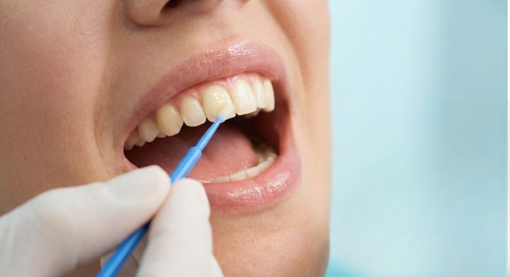 Fluoride Treatment
