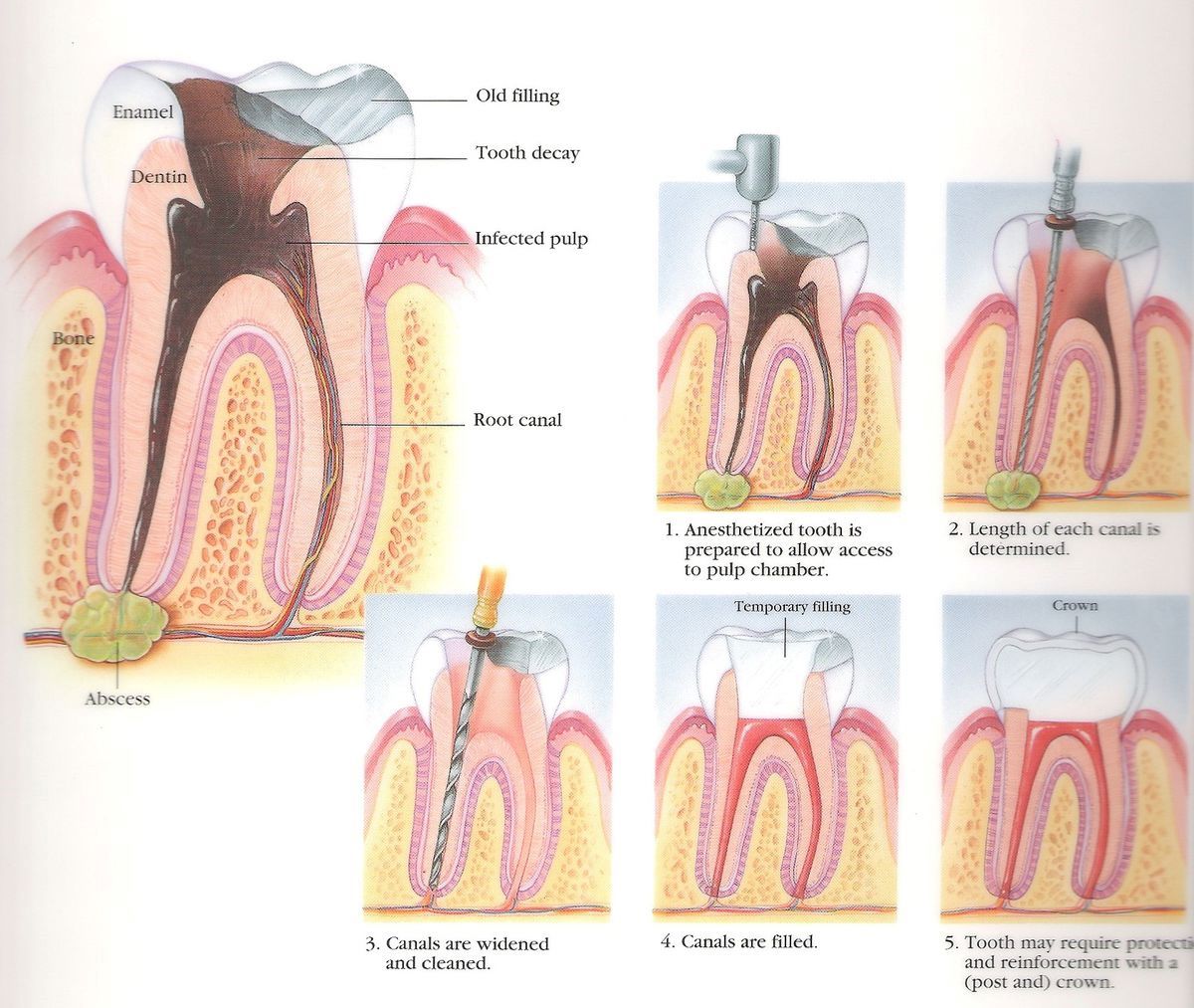Root Canal Treatment in Milton, Step-by-Step Procedure | White Dove Dental Step-by-step root canal treatment in Milton illustration showing infected pulp removal, canal cleaning, filling, and crown placement