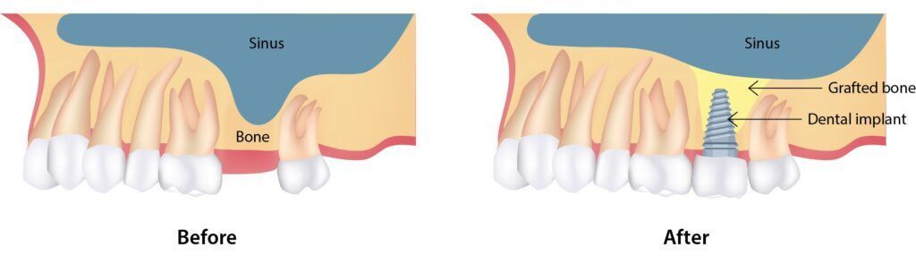 Sinus Lift Procedure in Milton, Before and After Bone Grafting for Dental Implants Before and after diagram of a sinus lift in Milton showing bone graft and dental implant placement
