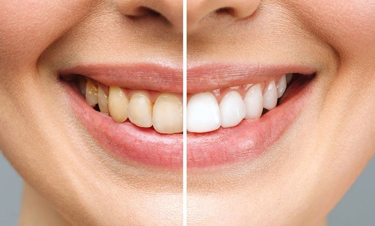 Teeth Whitening