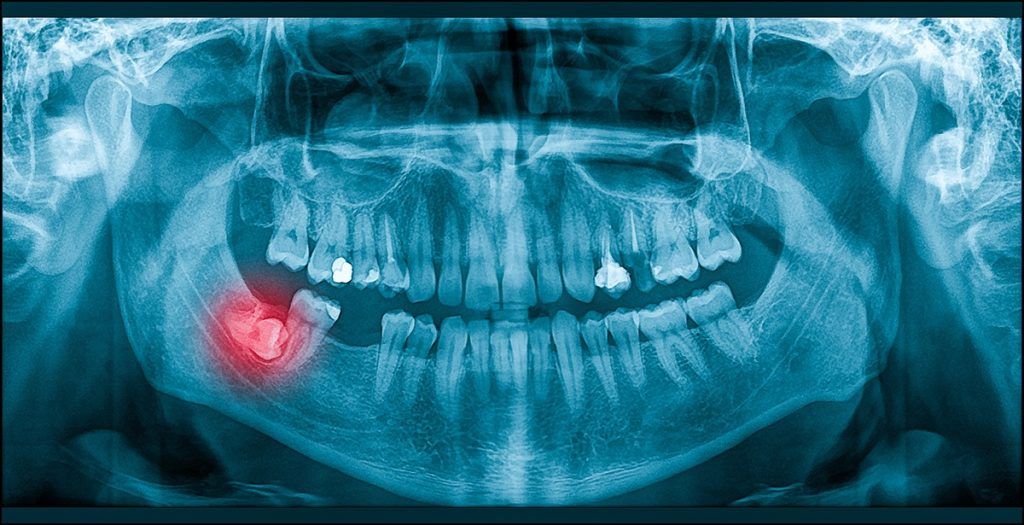 Wisdom Teeth Extraction in Milton, Impacted Third Molar X-Ray | White Dove Dental Panoramic dental X-ray highlighting an impacted lower wisdom tooth assessed for wisdom teeth extraction in Milton